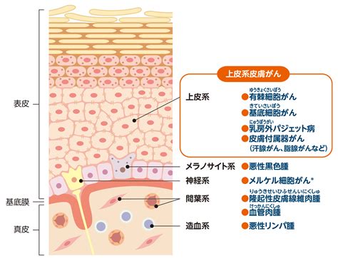 皮膚癌|皮膚がんの分類